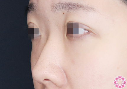 年代：20代 施術名：プチ隆鼻術（ヒアルロン酸） 施術前｜【公式】東京形成美容外科