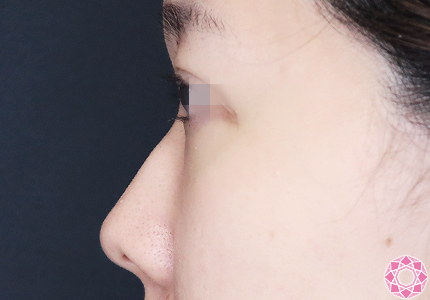 年代：20代 施術名：プチ隆鼻術（ヒアルロン酸） 施術前｜【公式】東京形成美容外科