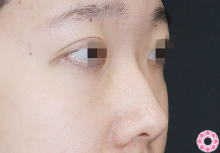 年代：20代 施術名：プチ隆鼻術（ヒアルロン酸） 施術前｜【公式】東京形成美容外科