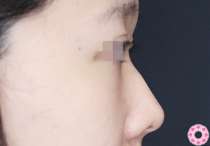 年代：20代 施術名：プチ隆鼻術（ヒアルロン酸） 施術前｜【公式】東京形成美容外科