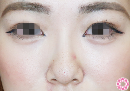 年代：20代 施術名：プチ隆鼻術（ヒアルロン酸） 施術後｜【公式】東京形成美容外科