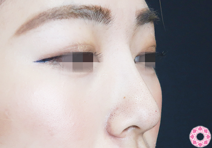 年代：20代 施術名：プチ隆鼻術（ヒアルロン酸） 施術後｜【公式】東京形成美容外科