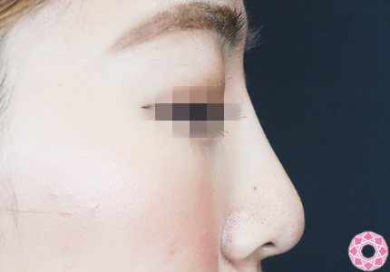 年代：20代 施術名：プチ隆鼻術（ヒアルロン酸） 施術後｜【公式】東京形成美容外科