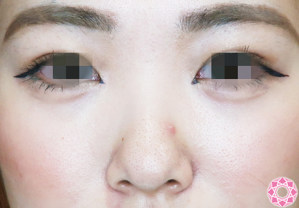 年代：20代 施術名：プチ隆鼻術（ヒアルロン酸） 施術前｜【公式】東京形成美容外科