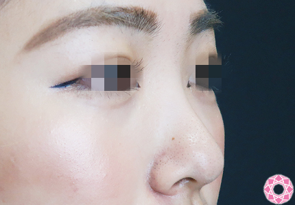 年代：20代 施術名：プチ隆鼻術（ヒアルロン酸） 施術前｜【公式】東京形成美容外科