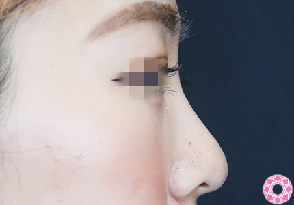 年代：20代 施術名：プチ隆鼻術（ヒアルロン酸） 施術前｜【公式】東京形成美容外科