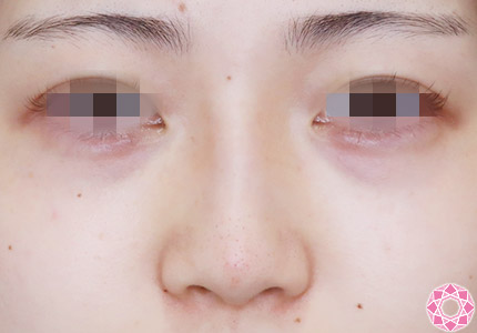 年代：20代 施術名：プチ隆鼻術（ヒアルロン酸） 施術後｜【公式】東京形成美容外科