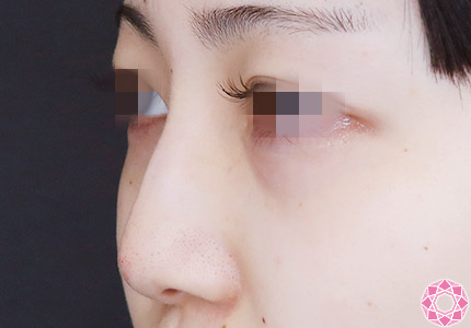 年代：20代 施術名：プチ隆鼻術（ヒアルロン酸） 施術後｜【公式】東京形成美容外科