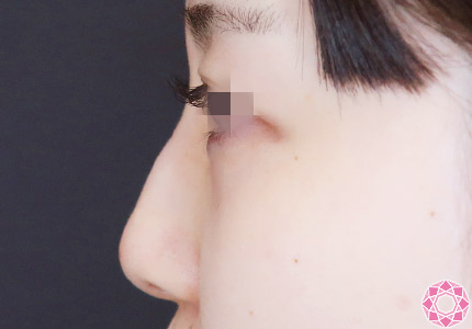 年代：20代 施術名：プチ隆鼻術（ヒアルロン酸） 施術後｜【公式】東京形成美容外科