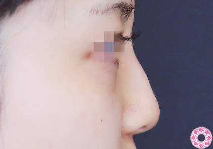 年代：20代 施術名：プチ隆鼻術（ヒアルロン酸） 施術後｜【公式】東京形成美容外科