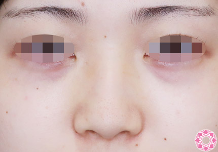 年代：20代 施術名：プチ隆鼻術（ヒアルロン酸） 施術前｜【公式】東京形成美容外科