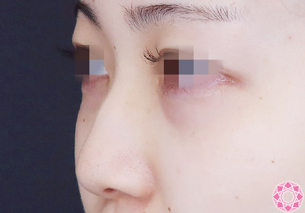 年代：20代 施術名：プチ隆鼻術（ヒアルロン酸） 施術前｜【公式】東京形成美容外科