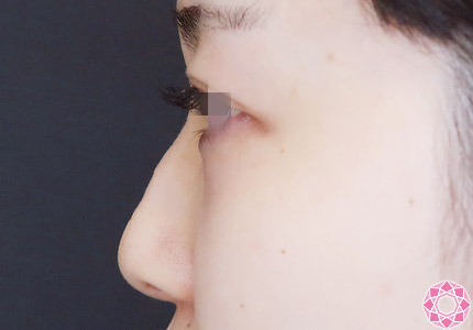 年代：20代 施術名：プチ隆鼻術（ヒアルロン酸） 施術前｜【公式】東京形成美容外科