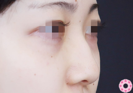 年代：20代 施術名：プチ隆鼻術（ヒアルロン酸） 施術前｜【公式】東京形成美容外科