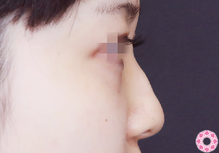 年代：20代 施術名：プチ隆鼻術（ヒアルロン酸） 施術前｜【公式】東京形成美容外科