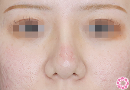 年代：20代 施術名：プチ隆鼻術（ヒアルロン酸） 施術後｜【公式】東京形成美容外科