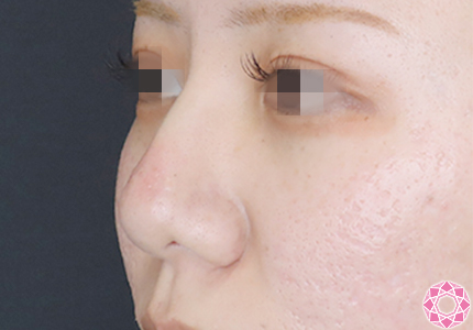 年代：20代 施術名：プチ隆鼻術（ヒアルロン酸） 施術後｜【公式】東京形成美容外科