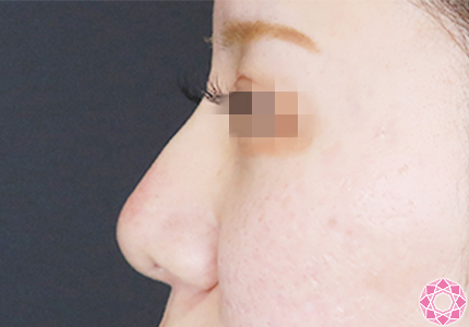 年代：20代 施術名：プチ隆鼻術（ヒアルロン酸） 施術後｜【公式】東京形成美容外科