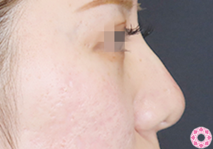 年代：20代 施術名：プチ隆鼻術（ヒアルロン酸） 施術後｜【公式】東京形成美容外科