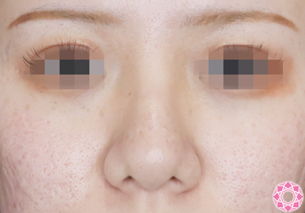 年代：20代 施術名：プチ隆鼻術（ヒアルロン酸） 施術前｜【公式】東京形成美容外科