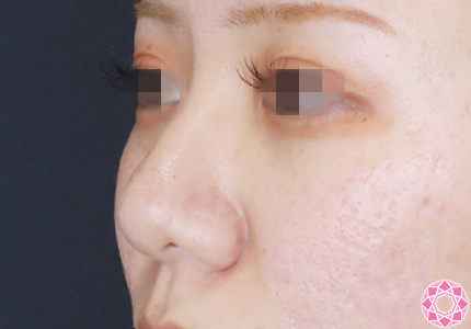 年代：20代 施術名：プチ隆鼻術（ヒアルロン酸） 施術前｜【公式】東京形成美容外科