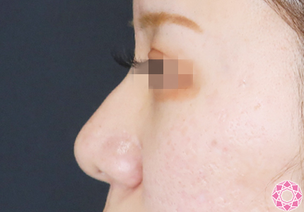 年代：20代 施術名：プチ隆鼻術（ヒアルロン酸） 施術前｜【公式】東京形成美容外科