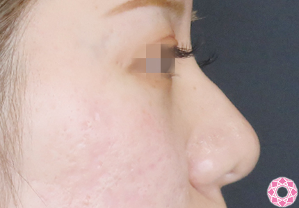 年代：20代 施術名：プチ隆鼻術（ヒアルロン酸） 施術前｜【公式】東京形成美容外科