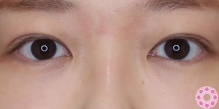 年代：20代 施術名：二重埋没法 施術後｜【公式】東京形成美容外科