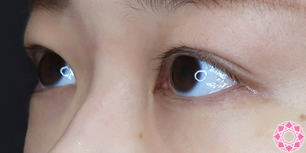 年代：20代 施術名：二重埋没法 施術後｜【公式】東京形成美容外科