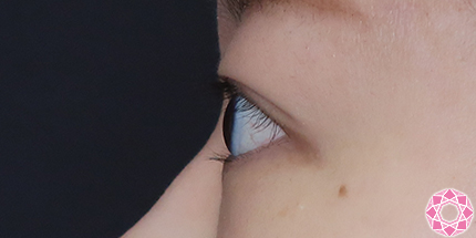 年代：20代 施術名：二重埋没法 施術後｜【公式】東京形成美容外科