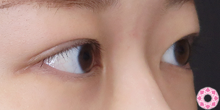 年代：20代 施術名：二重埋没法 施術後｜【公式】東京形成美容外科