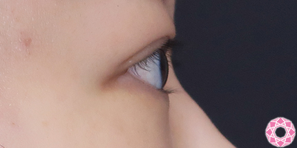 年代：20代 施術名：二重埋没法 施術後｜【公式】東京形成美容外科