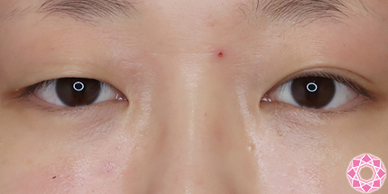 年代：20代 施術名：二重埋没法 施術前｜【公式】東京形成美容外科