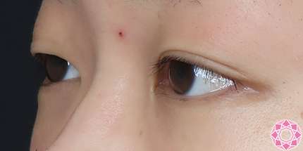 年代：20代 施術名：二重埋没法 施術前｜【公式】東京形成美容外科