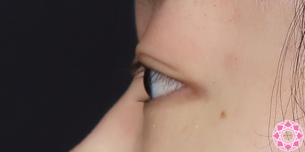 年代：20代 施術名：二重埋没法 施術前｜【公式】東京形成美容外科