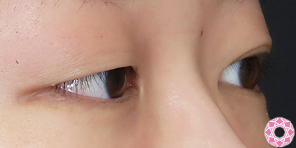 年代：20代 施術名：二重埋没法 施術前｜【公式】東京形成美容外科