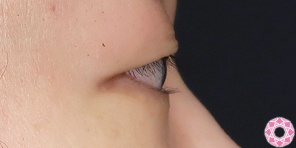 年代：20代 施術名：二重埋没法 施術前｜【公式】東京形成美容外科