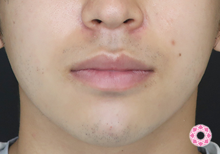 年代：20代 施術名：アゴのヒアルロン酸注入 施術後｜【公式】東京形成美容外科