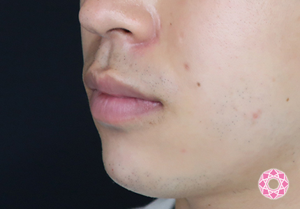 年代：20代 施術名：アゴのヒアルロン酸注入 施術後｜【公式】東京形成美容外科