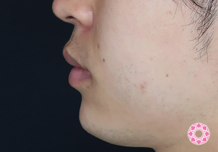 年代：20代 施術名：アゴのヒアルロン酸注入 施術後｜【公式】東京形成美容外科