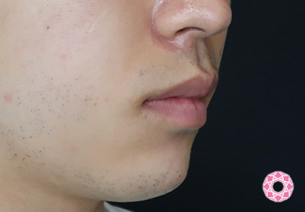 年代：20代 施術名：アゴのヒアルロン酸注入 施術後｜【公式】東京形成美容外科