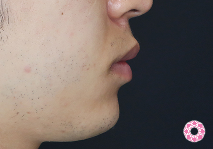 年代：20代 施術名：アゴのヒアルロン酸注入 施術後｜【公式】東京形成美容外科