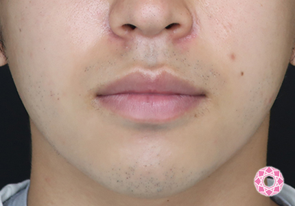 年代：20代 施術名：アゴのヒアルロン酸注入 施術前｜【公式】東京形成美容外科