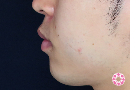 年代：20代 施術名：アゴのヒアルロン酸注入 施術前｜【公式】東京形成美容外科