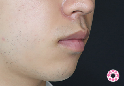 年代：20代 施術名：アゴのヒアルロン酸注入 施術前｜【公式】東京形成美容外科