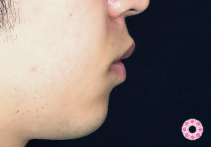 年代：20代 施術名：アゴのヒアルロン酸注入 施術前｜【公式】東京形成美容外科