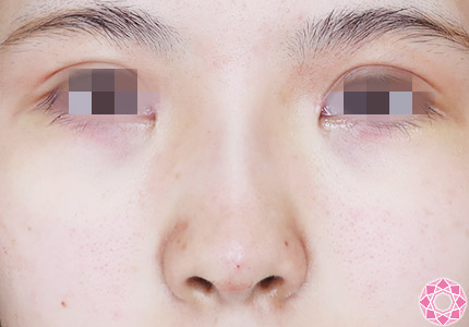 年代：20代 施術名：プチ隆鼻術（ヒアルロン酸） 施術後｜【公式】東京形成美容外科