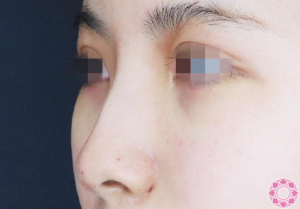 年代：20代 施術名：プチ隆鼻術（ヒアルロン酸） 施術後｜【公式】東京形成美容外科