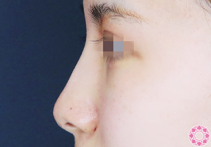 年代：20代 施術名：プチ隆鼻術（ヒアルロン酸） 施術後｜【公式】東京形成美容外科