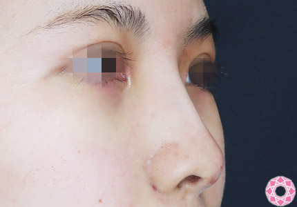 年代：20代 施術名：プチ隆鼻術（ヒアルロン酸） 施術後｜【公式】東京形成美容外科